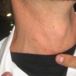Matt Redder's Neck Incision